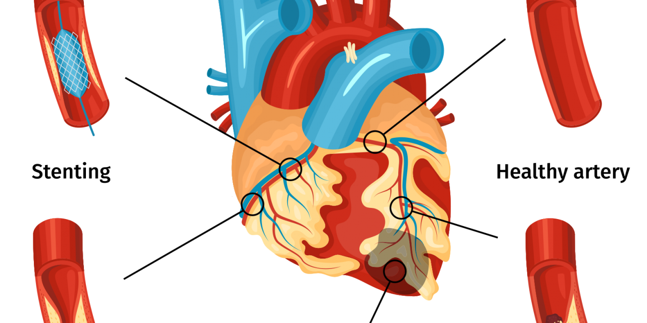 La quantità di colesterolo ossidato, non totale, è correlata al rischio cardiovascolare